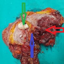 Εκτεμημένο παρασκεύασμα en bloc. Κόκκινο βέλος αδενοκαρκίνωμα ορθοσιγμοειδούς. Πράσινο βέλος μήτρα – ινομυώματα μήτρας. Μοβ βέλος κεκρυμμένο ψαμμοκαρκίνωμα αριστερής ωοθήκης (Ευγενική παραχώρηση Dr. V. Penopoulos)