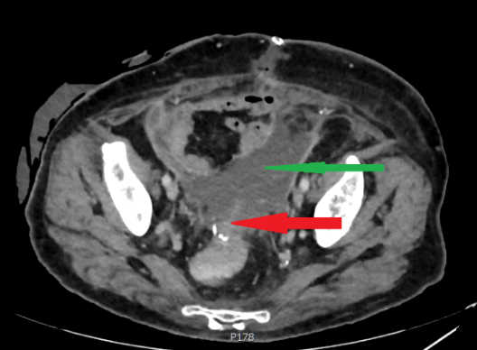 Μικροσκοπική εικόνα εκτεταμένου σχηματισμού ψαμμωδών σωματίων (Ευγενική παραχώρηση Dr. V. Penopoulos)