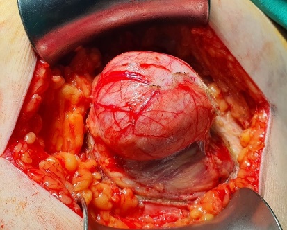 Διεγχειρητική εικόνα κήλης Spiegel (Ευγενική παραχώρηση Dr. V. Penopoulos).