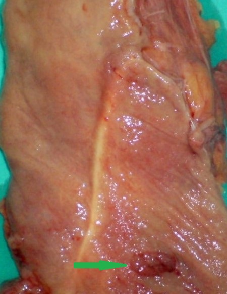 Adenocarcinoma seen at lower ileal pouch margin (Courtesy Dr. V. Penopoulos)