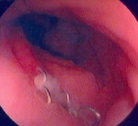 Endoscopic view of ileal pouch - anal anastomosis 3 years before the development of adenocarcinoma (Courtesy Dr. V. Penopoulos)