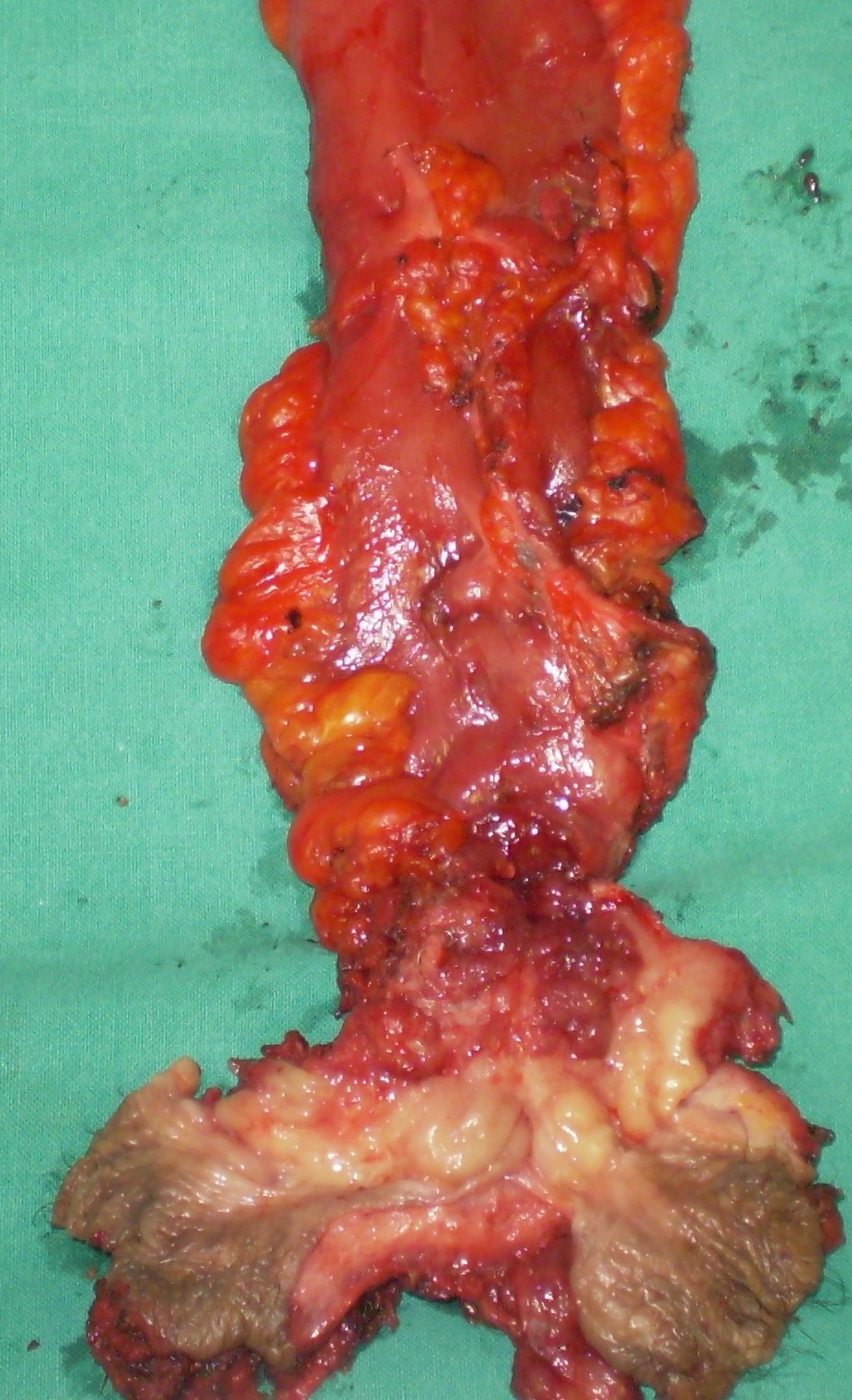 The adenocarcinoma is clearly seen nearby the ileal pouch anal anastomosis (Courtesy Dr. V. Penopoulos)