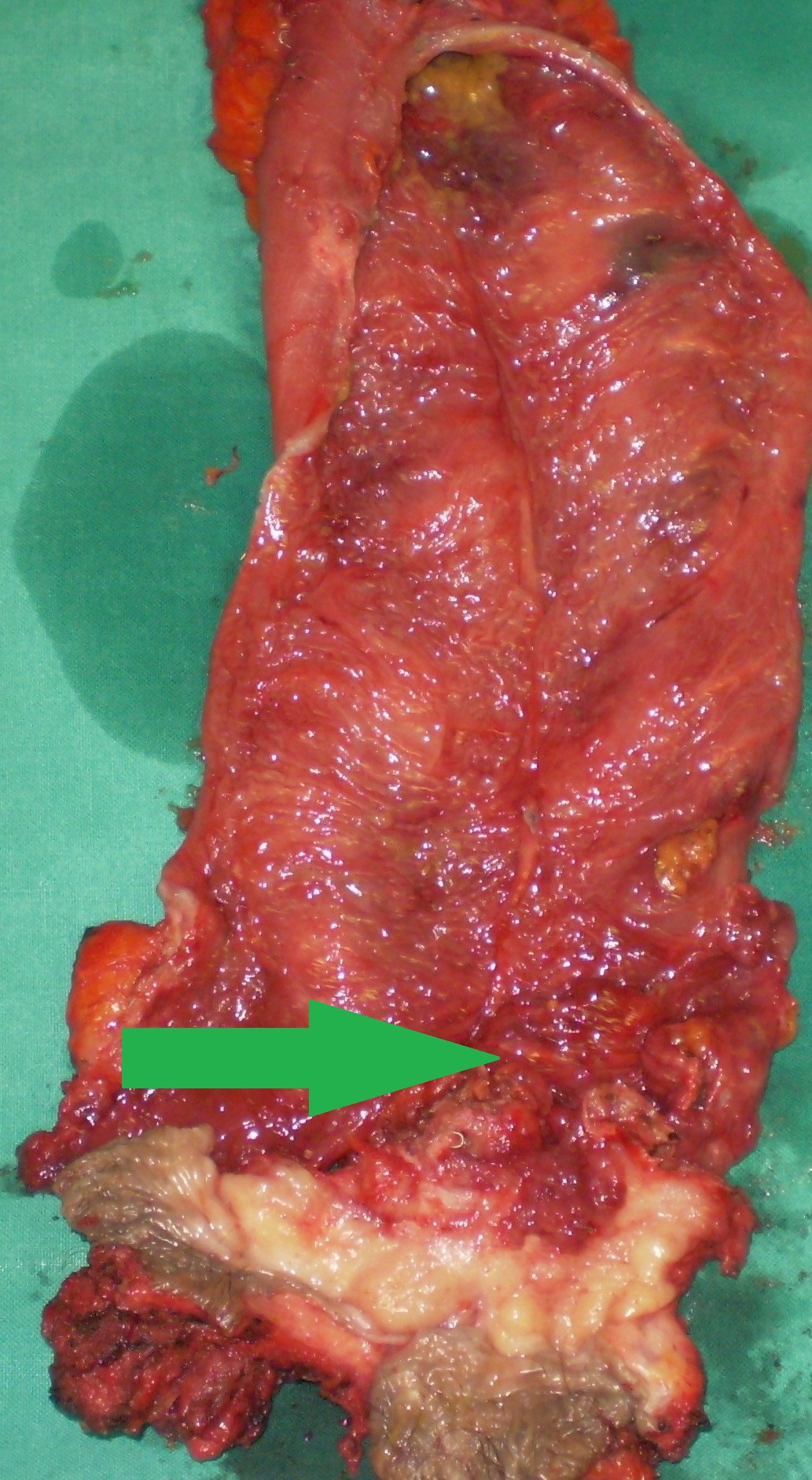 The adenocarcinoma is clearly seen nearby the ileal pouch anal anastomosis (Courtesy Dr. V. Penopoulos)