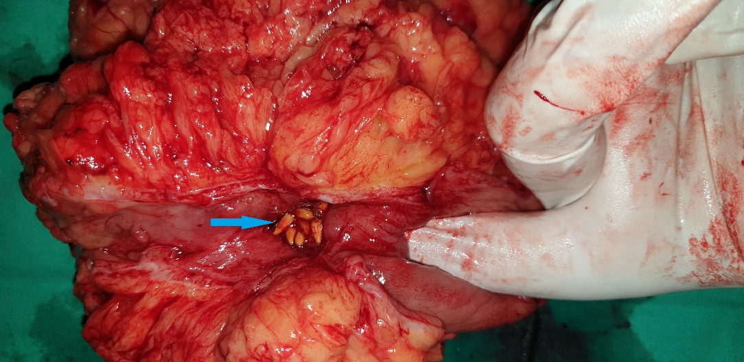 Extreme stenosis of the involved transverse colon . Residual seeds were unable to overcome the stenotic segment (Courtesy Dr. V. Penopoulos)