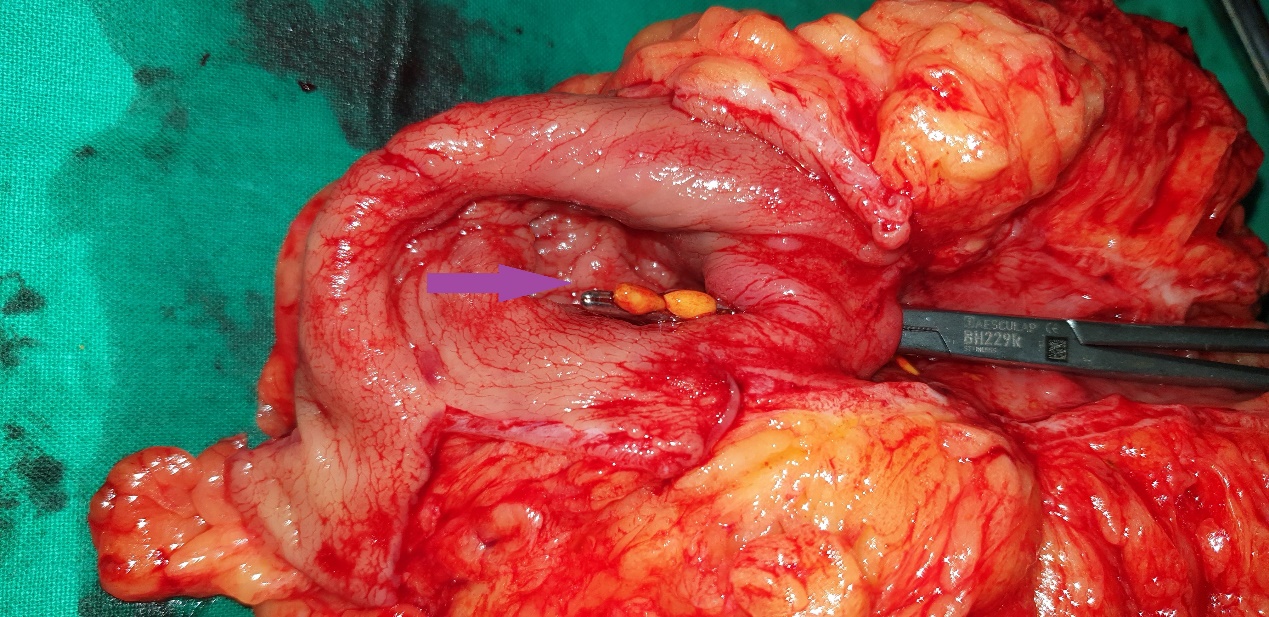 Forceps passed violently through the colonic stenosis (Courtesy Dr. V. Penopoulos)
