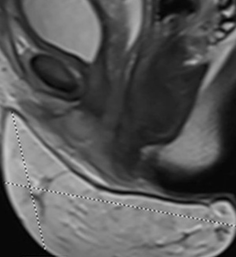 Λίπωμα. Παλαιά νέκρωση λίπους (FN) με ίνωση και δυστροφική ασβεστοποίηση. Τα νεκρωτικά λιποκύτταρα στερούνται πυρήνων (Ευγενική παραχώρηση Dr. V. Penopoulos)