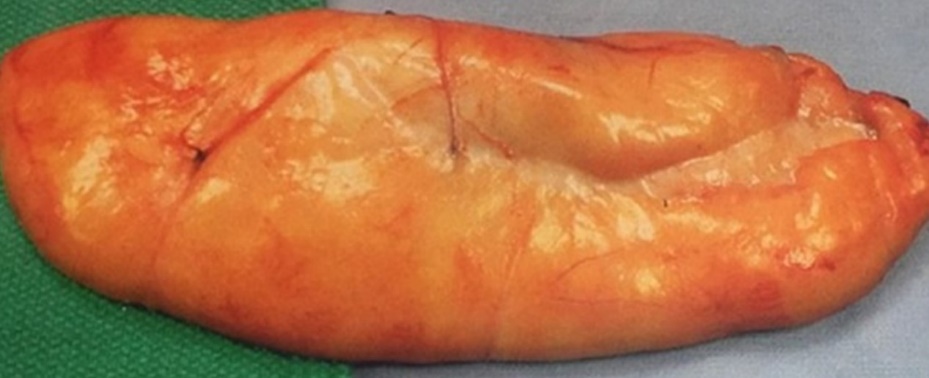 Η πλήρης αφαίρεση του λιπώματος είναι προφανής (Ευγενική παραχώρηση Dr. V. Penopoulos)