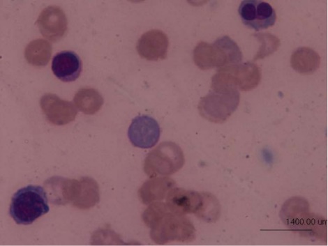 A metastatic deposit on the excised gallbladder (Courtesy Dr. V. Penopoulos)