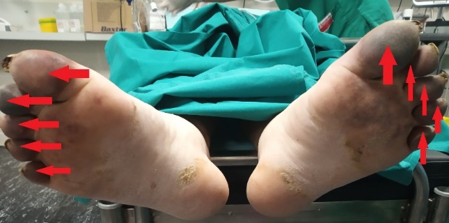 A  metastatic  deposit  on  the  excised  gallbladder (Courtesy Dr. V. Penopoulos)