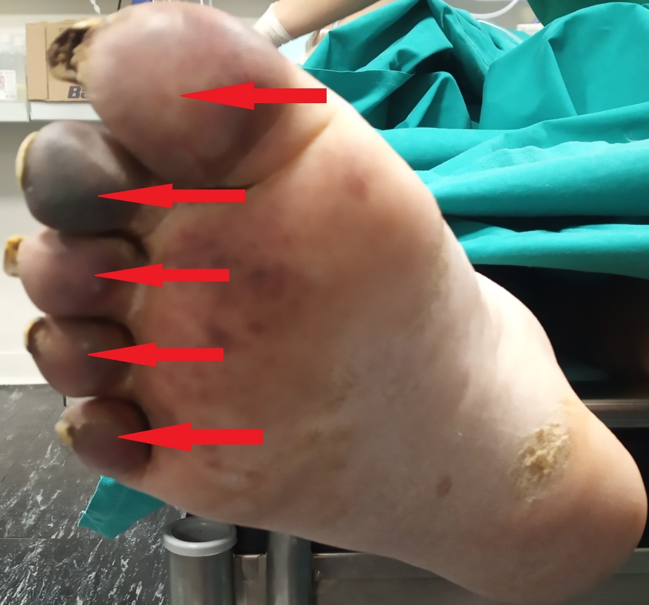 A  metastatic  deposit  on  the  excised  gallbladder (Courtesy Dr. V. Penopoulos)