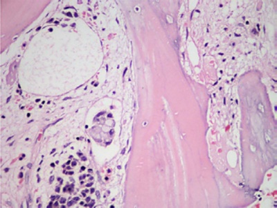 A  metastatic  deposit  on  the  excised  gallbladder (Courtesy Dr. V. Penopoulos)