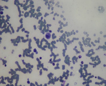 A  metastatic  deposit  on  the  excised  gallbladder (Courtesy Dr. V. Penopoulos)