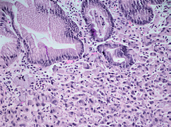 The excised gastric carcinoma (Courtesy Dr. V. Penopoulos)