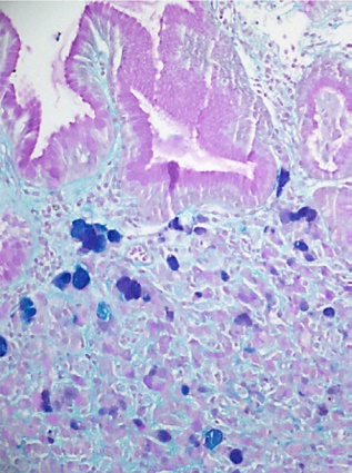 A metastatic deposit on the excised gallbladder (Courtesy Dr. V. Penopoulos)