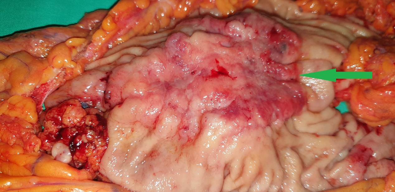 A metastatic deposit on the excised gallbladder (Courtesy Dr. V. Penopoulos)
