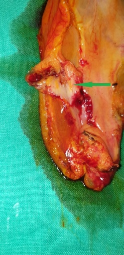 A metastatic deposit on the excised gallbladder (Courtesy Dr. V. Penopoulos)
