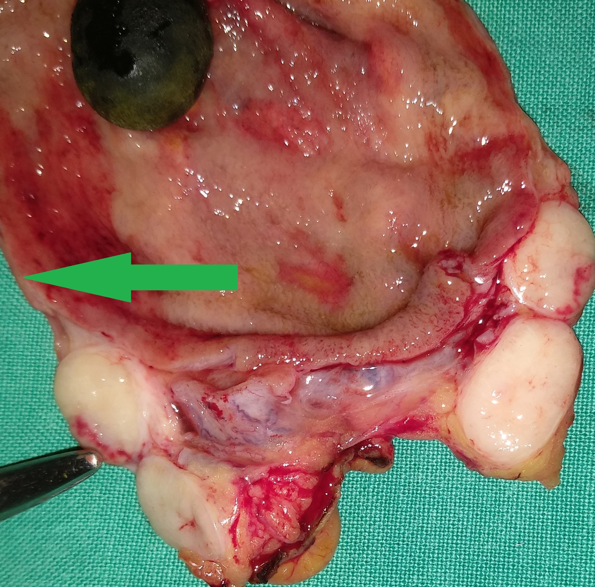 Total Hysterectomy specimen .Both ovaries occupied by the signet cell gallbladder carcinoma (Courtesy Dr. V. Penopoulos)