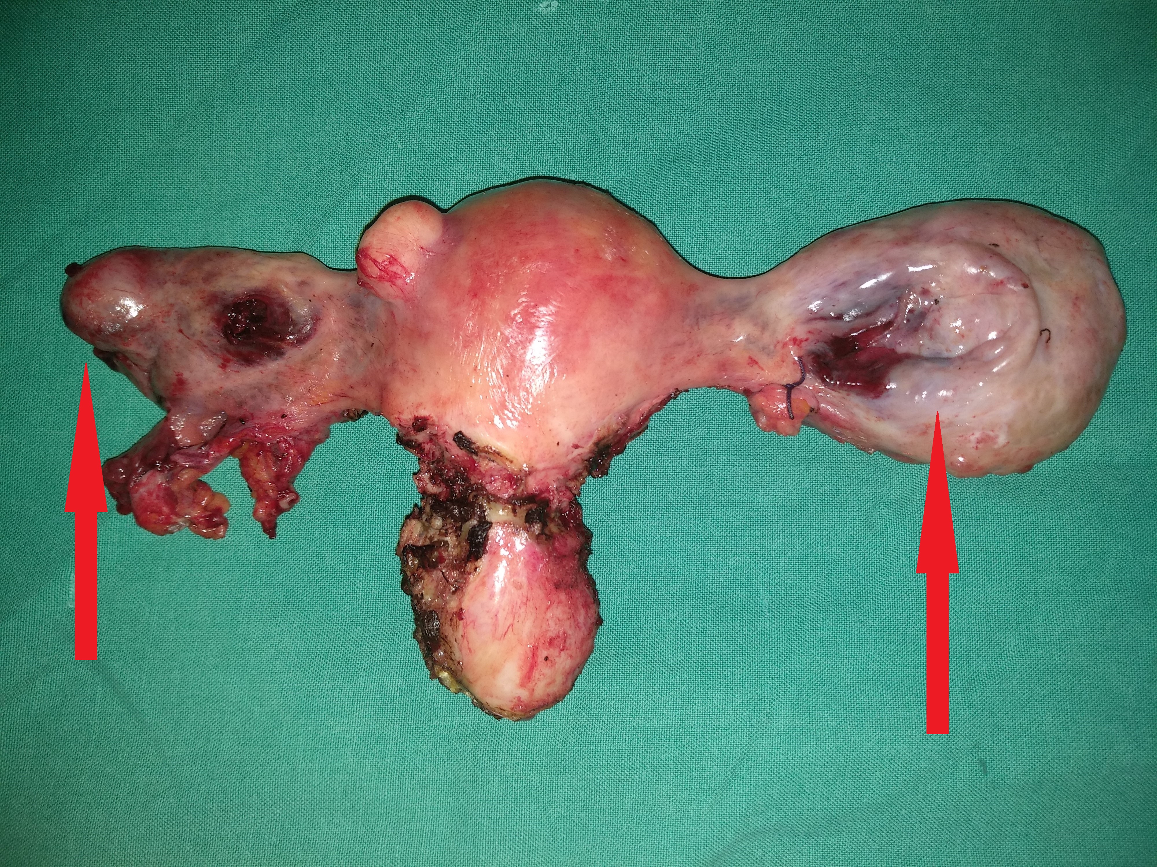 Total Hysterectomy specimen .Both ovaries occupied by the signet cell gallbladder carcinoma (Courtesy Dr. V. Penopoulos)