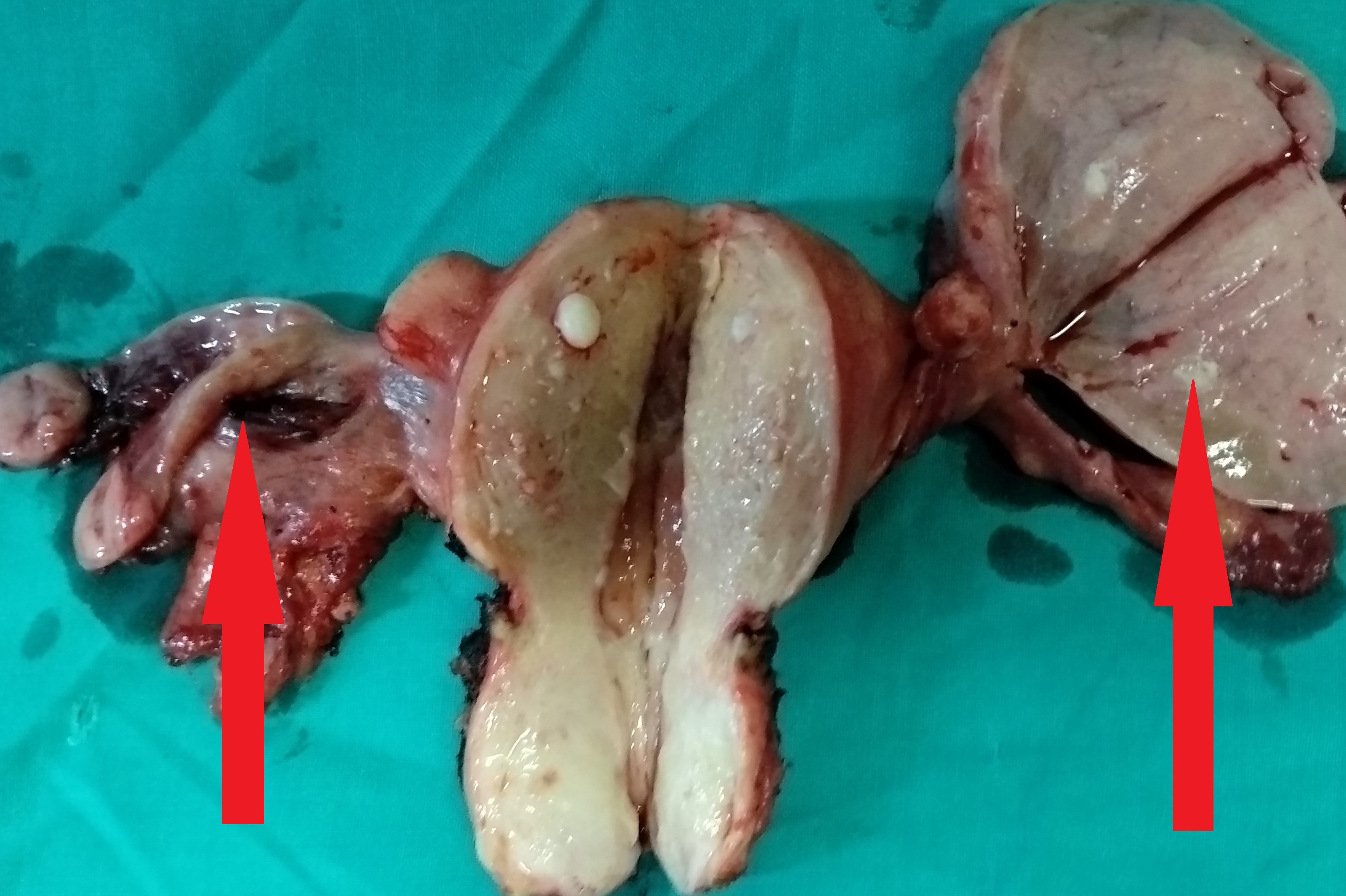 Total Hysterectomy specimen .Both ovaries occupied by the signet cell gallbladder carcinoma (Courtesy Dr. V. Penopoulos)