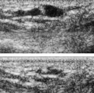 Κιρσοί δακτύλων σταδίου ΙΙΙ (Ευγενική παραχώρηση Dr. V. Penopoulos)