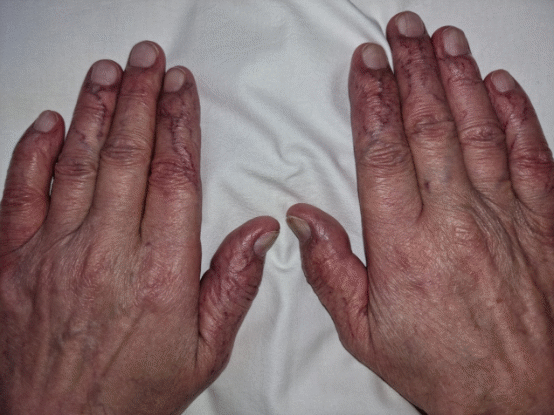 Κιρσοί δακτύλων σταδίου ΙΙΙ (Ευγενική παραχώρηση Dr. V. Penopoulos)