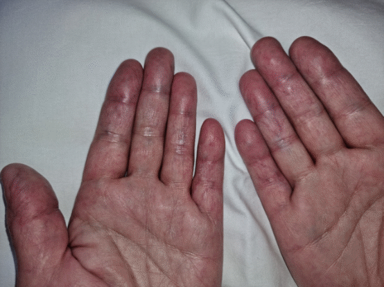 Κιρσοί δακτύλων σταδίου ΙΙΙ (Ευγενική παραχώρηση Dr. V. Penopoulos)