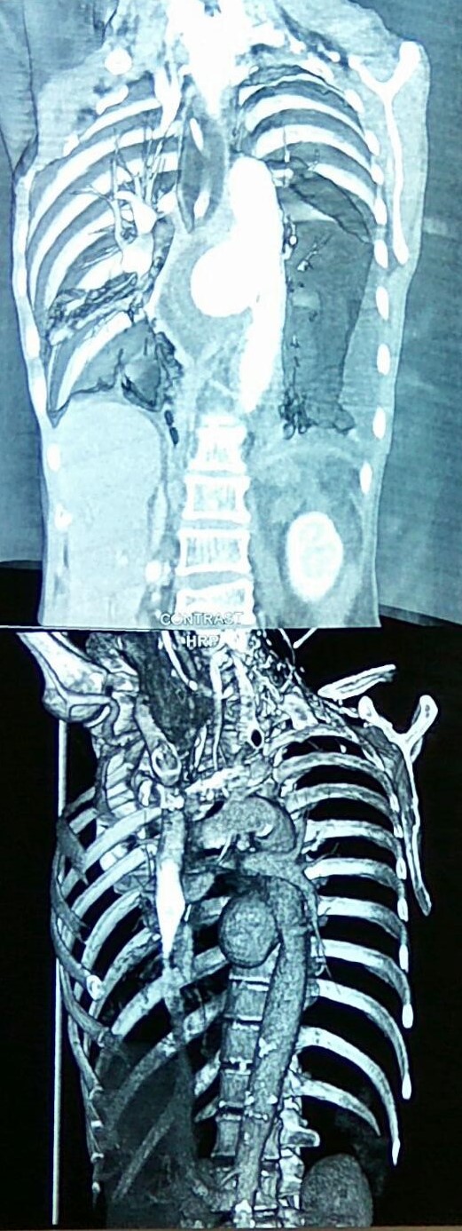 CT θώρακος 3η μετεγχειρητική ημέρα: Αορτικό stent σε θέση (κόκκινο βέλος). Ελάχιστος αέρας στο μεσοθωρακικό αιμάτωμα (πράσινο βέλος) (Ευγενική παραχώρηση Dr. V. Penopoulos)