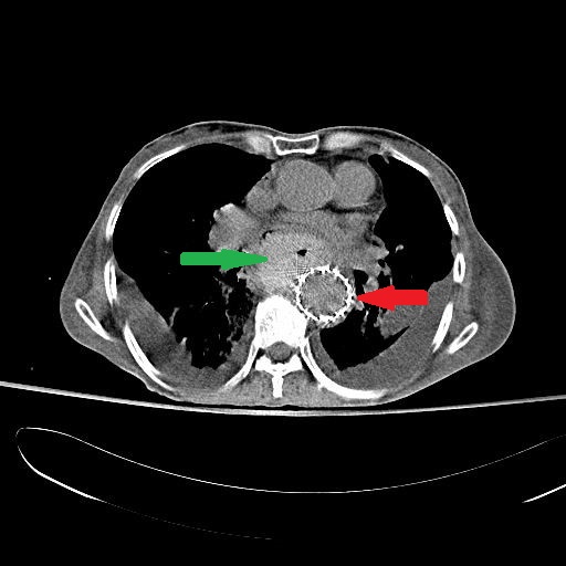 CT θώρακος 6η μετεγχειρητική ημέρα: αυξημένη συσσώρευση αέρα στο μεσοθωρακικό αιμάτωμα (κόκκινα βέλη) (Ευγενική παραχώρηση Dr. V. Penopoulos)