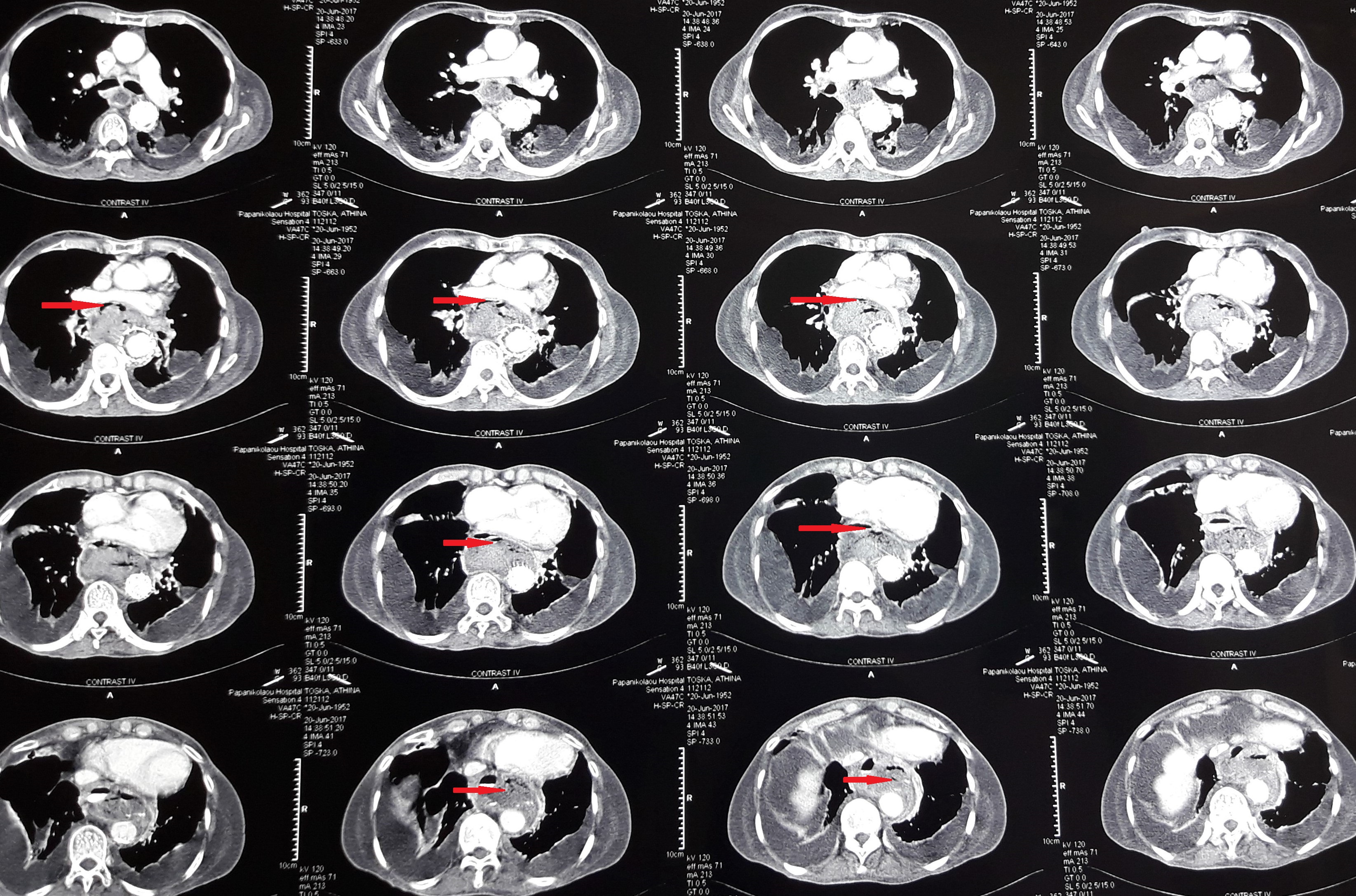 Οισοφαγογράφημα που ανέδειξε διαρροή σκιαγραφικού από μέσο οισοφάγο στο μεσοθωράκιο (πράσινο βέλος). Αορτικό stent σε θέση (κόκκινο βέλος) (Ευγενική παραχώρηση Dr. V. Penopoulos)