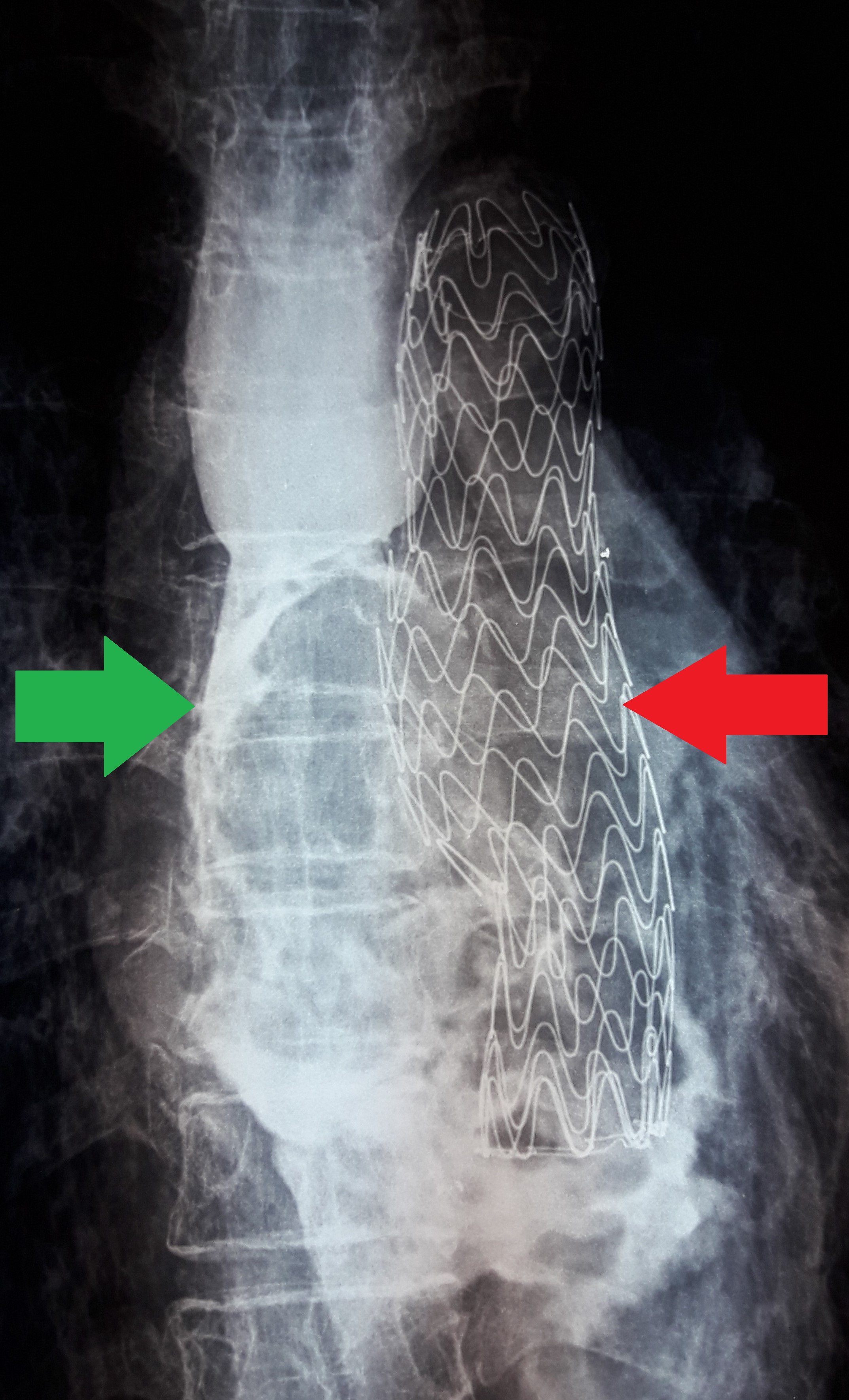 Οισοφαγικό (πράσινο βέλος) και θωρακικής αορτής (κόκκινο βέλος) stent σε θέση (Ευγενική παραχώρηση Dr. V. Penopoulos)