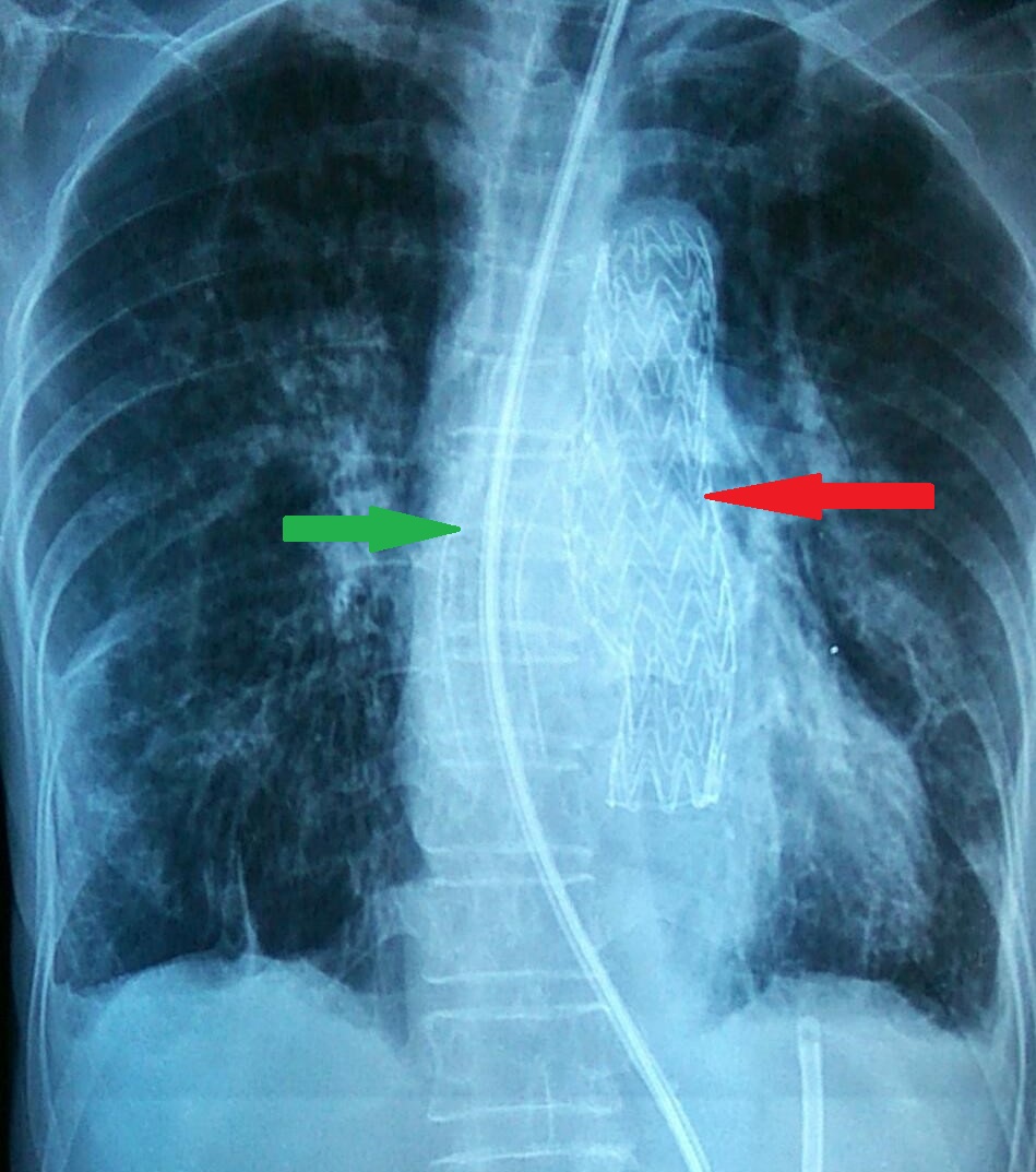 Οισοφαγικό (πράσινο βέλος) και θωρακικής αορτής (κόκκινο βέλος) stent σε θέση (Ευγενική παραχώρηση Dr. V. Penopoulos)