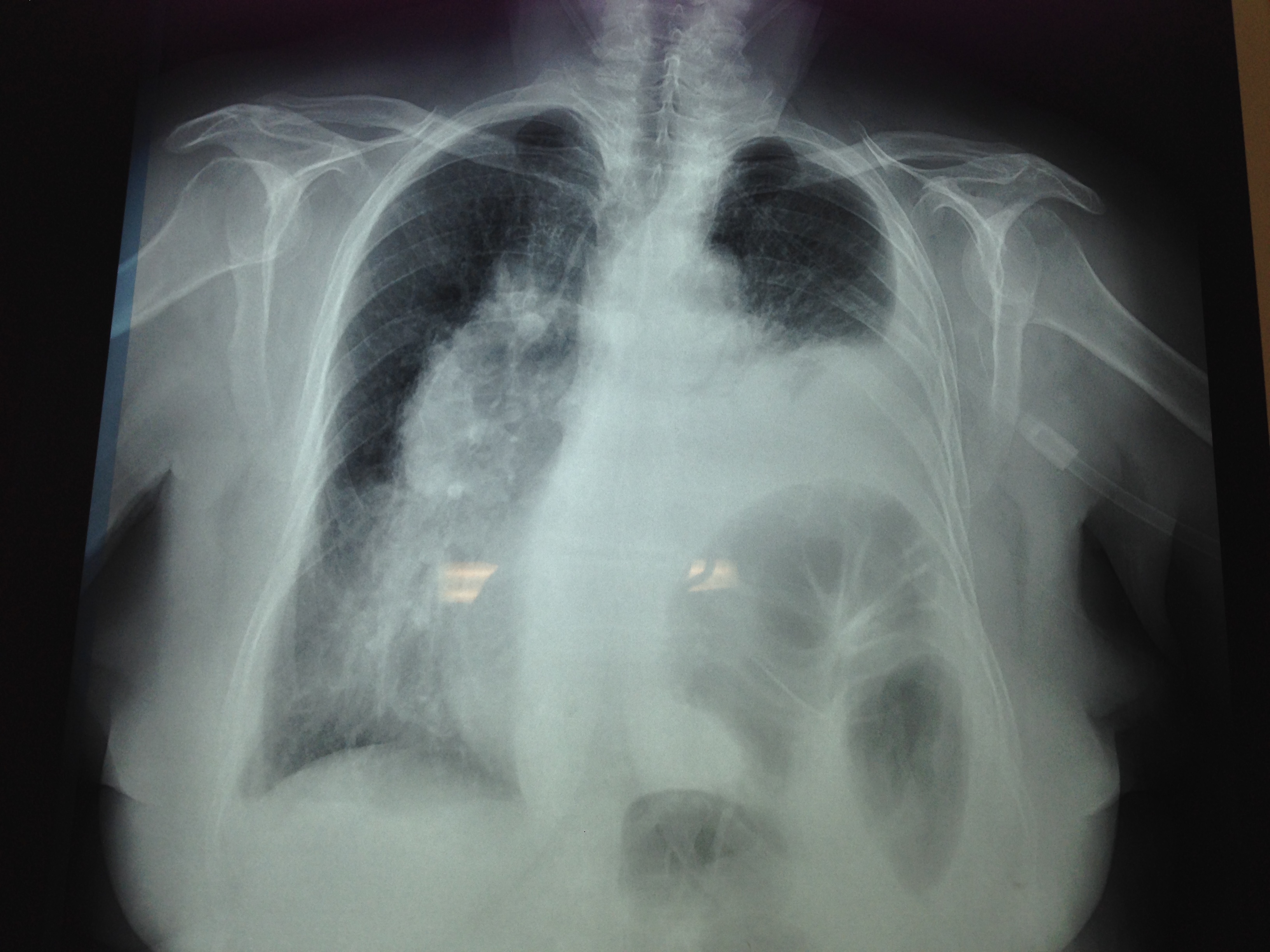 Προεγχειρητική (αριστερά) και μετεγχειρητική (δεξιά) ακτινογραφία θώρακος (Ευγενική παραχώρηση Dr. V. Penopoulos)