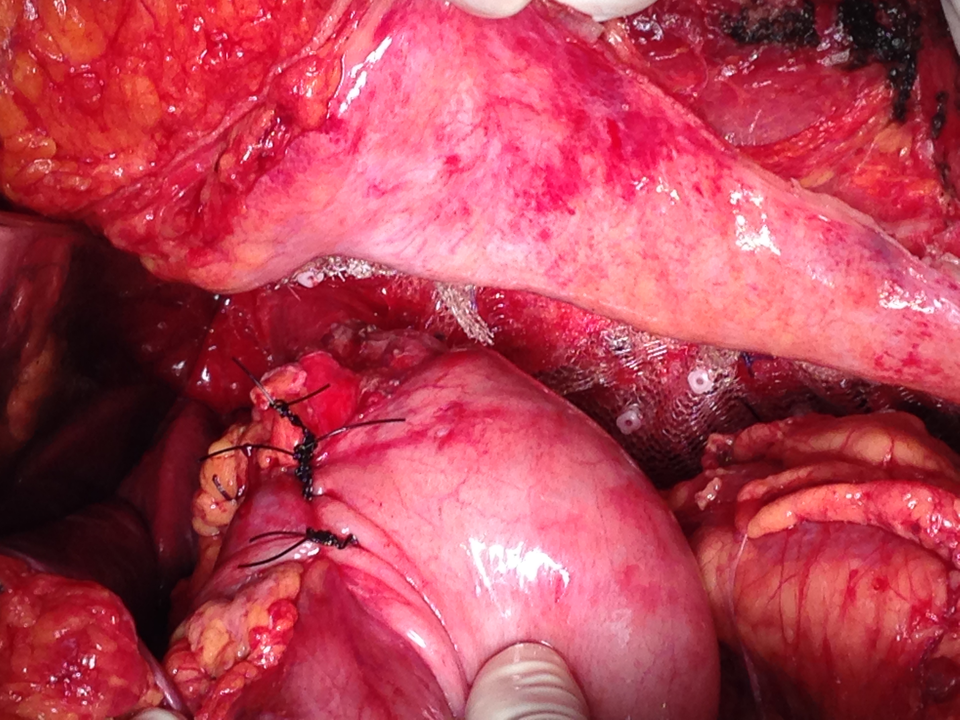 Η τελική εμφάνιση των ραμμάτων πλίκωσης, του επικαλυπτόμενου πλέγματος και της θεμελίωσης Nissen στο τέλος της επέμβασης (Ευγενική παραχώρηση Dr. V. Penopoulos)