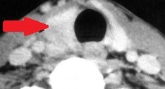 CT Scan indicating swollen right thyroid lobe with a sizable nodule in / adjacent to the right lower pole (Courtesy Dr. V. Penopoulos)