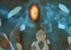 Subtraction scintigraphy suggestive of a right sided parathyroid adenoma and lack of thyroid perception (Courtesy Dr. V. Penopoulos)