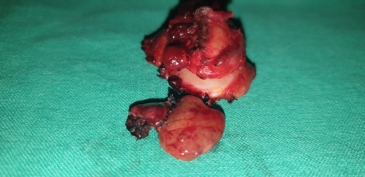 Subtraction scintigraphy suggestive of a right sided parathyroid adenoma and lack of thyroid perception (Courtesy Dr. V. Penopoulos)