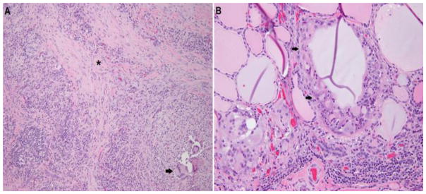 Subtraction scintigraphy suggestive of a right sided parathyroid adenoma and lack of thyroid perception (Courtesy Dr. V. Penopoulos)