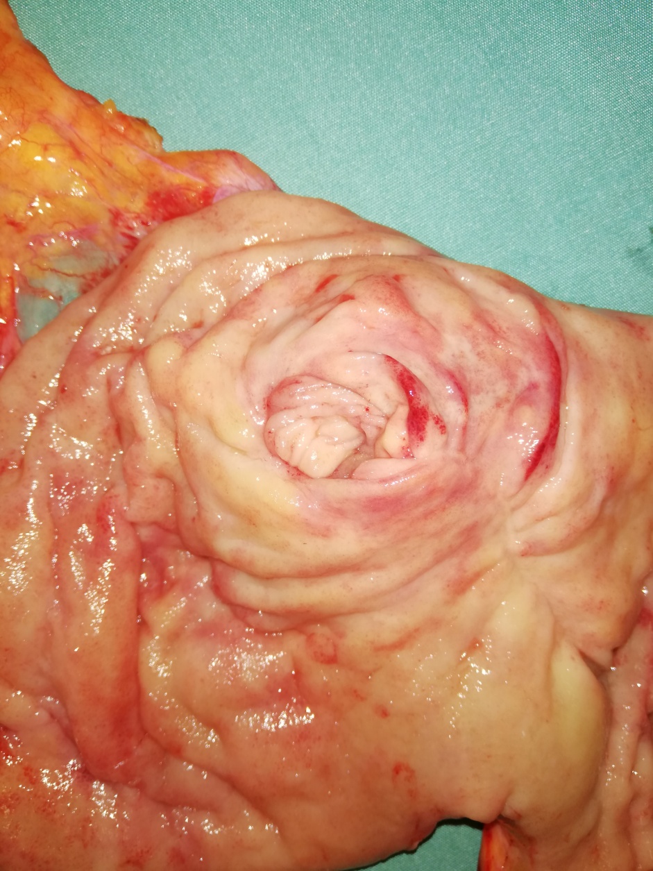 Completion Gastrectomy specimen (Courtesy Dr. V. Penopoulos)