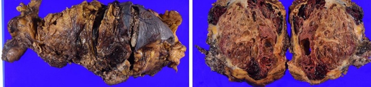 Pathological findings. The maximum diameter of the tumor was 35 cm (Courtesy Dr. V. Penopoulos)