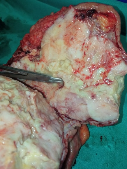 Pathological findings. The maximum diameter of the tumor was 35 cm (Courtesy Dr. V. Penopoulos)