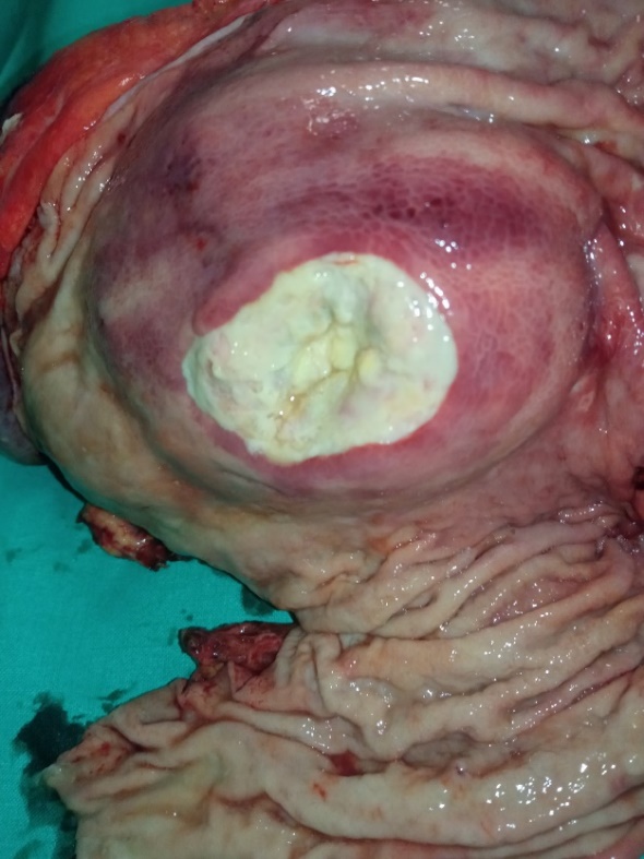 Pathological findings. The maximum diameter of the tumor was 35 cm (Courtesy Dr. V. Penopoulos)