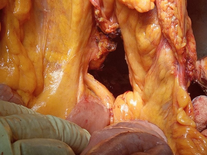 Pathological findings. The maximum diameter of the tumor was 35 cm (Courtesy Dr. V. Penopoulos)