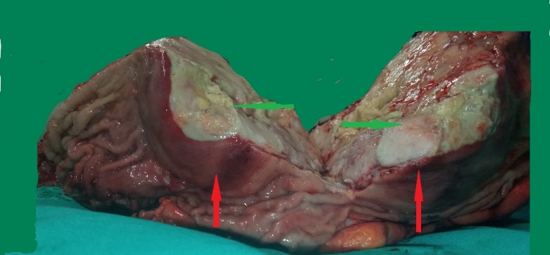 Pathological findings. The maximum diameter of the tumor was 35 cm (Courtesy Dr. V. Penopoulos)
