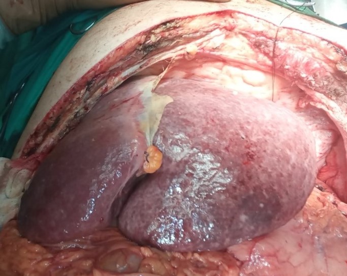 En bloc excision of the pancreatic carcinoma together with the stomach and spleen (Courtesy Dr. V. Penopoulos)