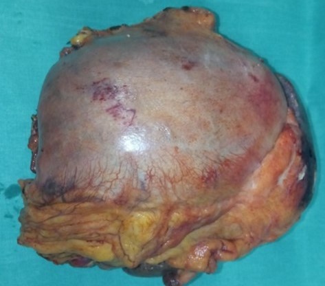 The area of gastric invasion by the expanding pancreatic carcinoma being the cause of intermittent bleeding (Courtesy Dr. V. Penopoulos)