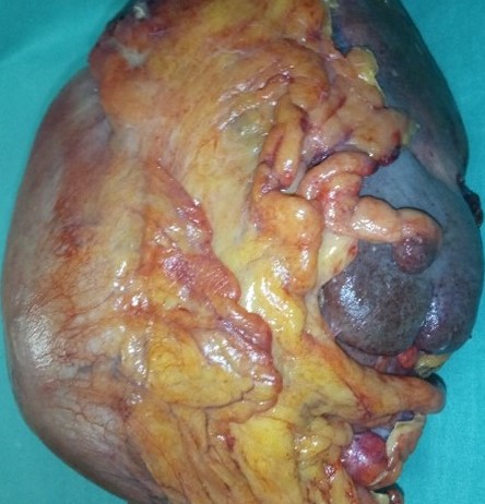 Operative field following excision of the huge pancreatic carcinoma (Courtesy Dr. V. Penopoulos)