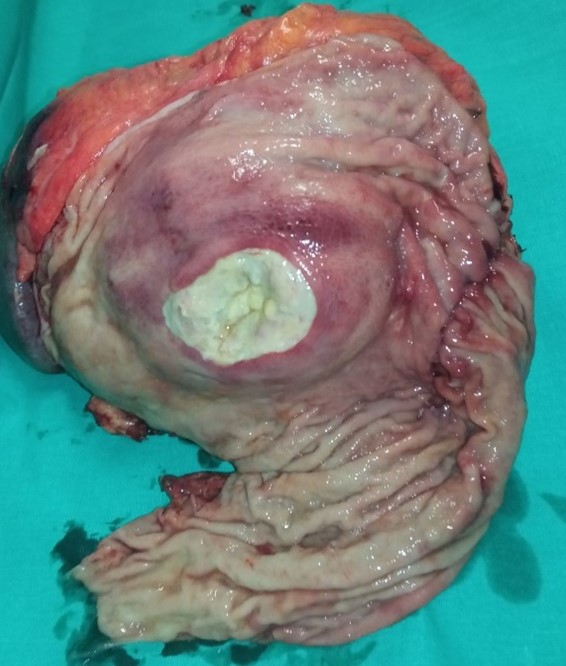 Pancreatic carcinoma opened post operatively. The central necrosis is pointed by forceps (Courtesy Dr. V. Penopoulos)