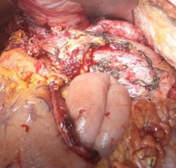 Sagittal opening of the specimen. Red arrows: gastric mucosa. Green arrows: Central pancreatic tumor necrosis (Courtesy Dr. V. Penopoulos)