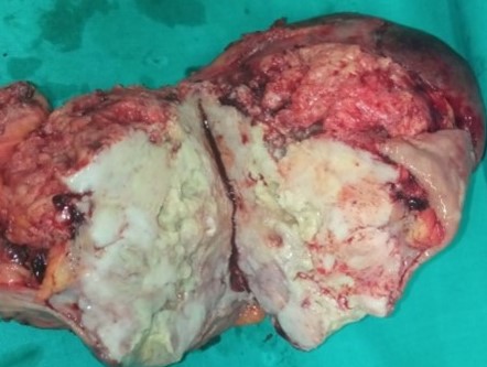 Pathological findings. The maximum diameter of the tumor was 35 cm (Courtesy Dr. V. Penopoulos)