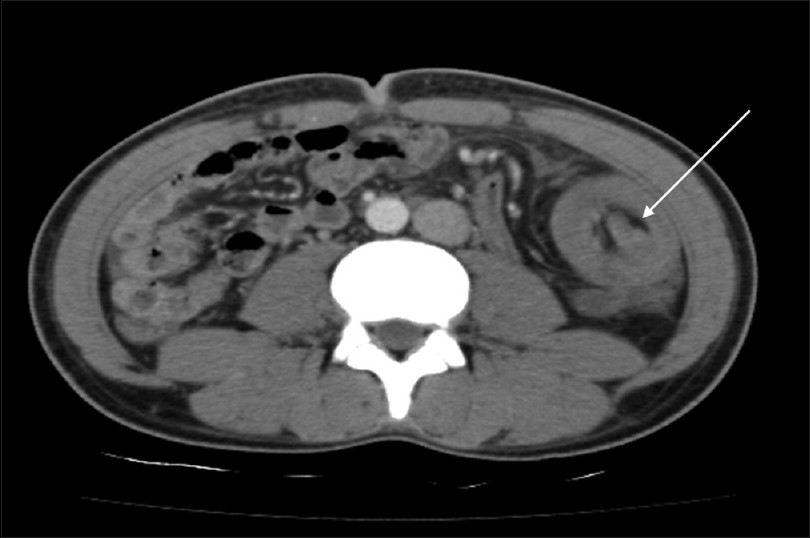 Αξονική τομογραφία κοιλίας (Ευγενική παραχώρηση Dr. V. Penopoulos)